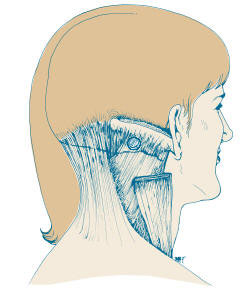 Splenius Capitis Neck Pain and Headache