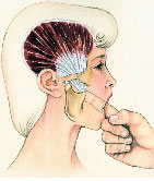 Temporal Tendonitis Headache