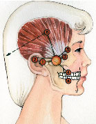 Temporal Tendonitis Headache